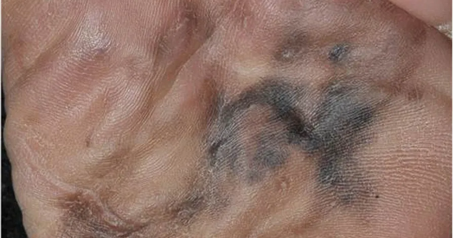 Acral lentiginous melanoma on the sole of a foot: a large, asymmetric brown and blue-black patch with ragged borders and several different shades, spreading across the ball of the foot toward the toes.