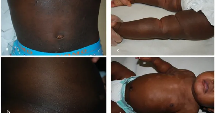 Atopic dermatitis on dark skin in children: tiny rough papules clustered around the hair follicles across a child's trunk (a, b), and the pale, faintly scaly patches of pityriasis alba on an infant's arm and torso (c, d).