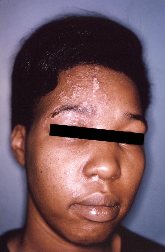 Crusted shingles blisters across one side of the forehead and eyelid on brown skin, not crossing the midline.