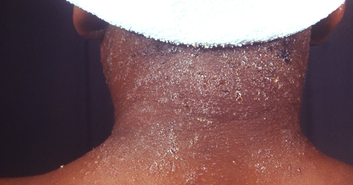 Seborrheic dermatitis on dark skin: fine white scale and small yellow crusts across the back of the neck, up to the hairline.