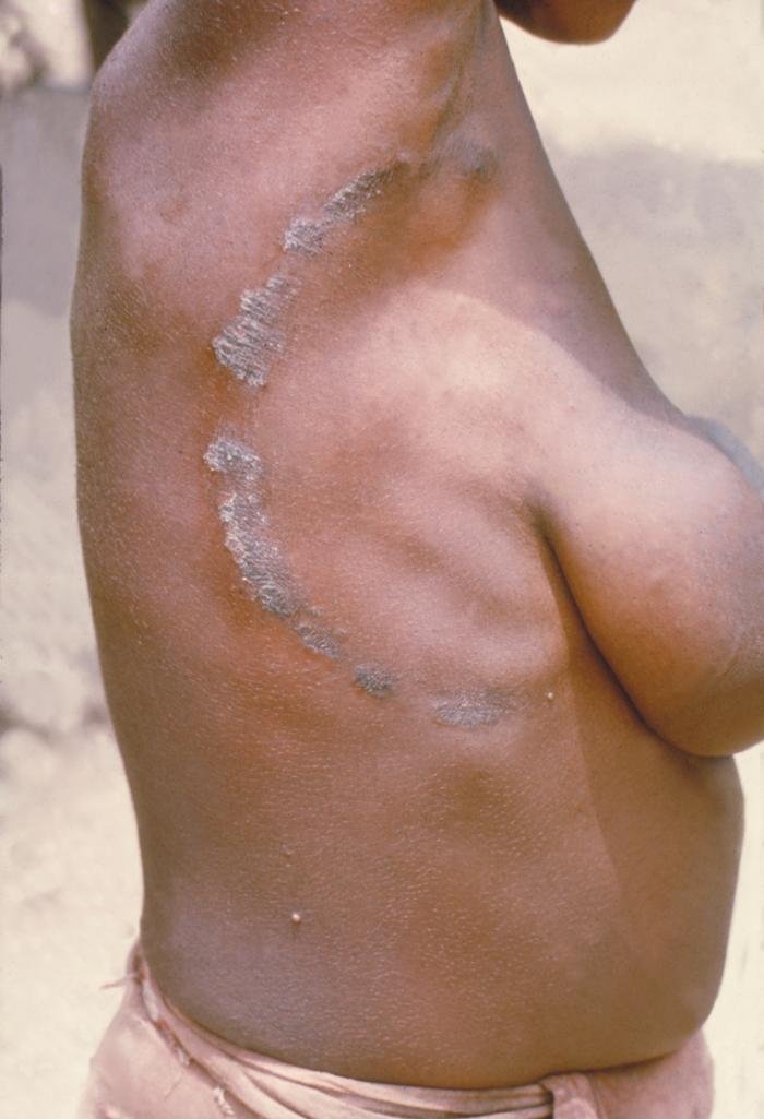 Ring-shaped scaly patch with a raised border on the side of a torso, on brown skin.