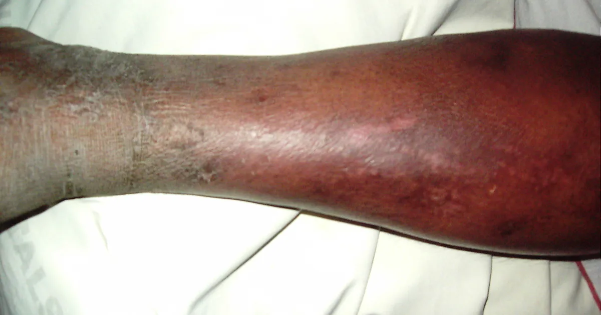A lower leg with cellulitis on brown skin: the infected calf is swollen and taut, a deep dusky red-brown rather than bright red, with a clear border where it meets the drier, lighter skin at the ankle.