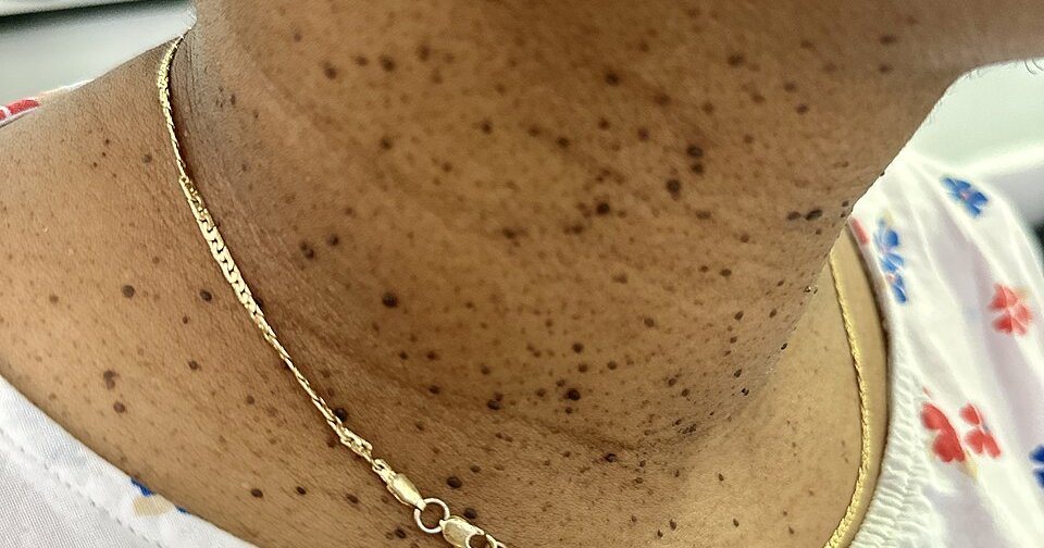 Dermatosis papulosa nigra on the neck and upper chest on brown skin. The lesions are small, dark and slightly raised.