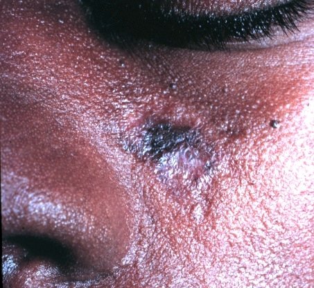 A small discoid lupus plaque with a dark rim and paler center on the cheek below the eye.