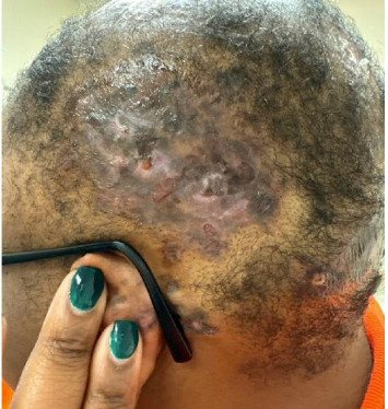 Violet-brown scarred patches and hair loss on the side of the scalp, with the patient holding her eyeglasses.