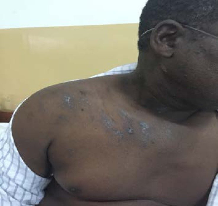 Crusted shingles lesions in a band across the shoulder and upper chest of a man with dark brown skin
