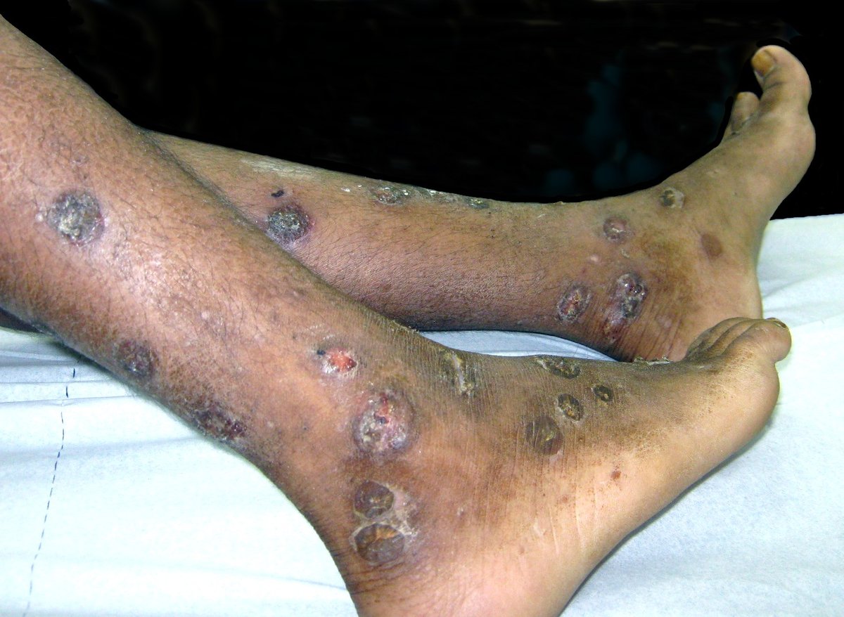 Round crusted impetigo sores with darker rims on dark brown lower legs.