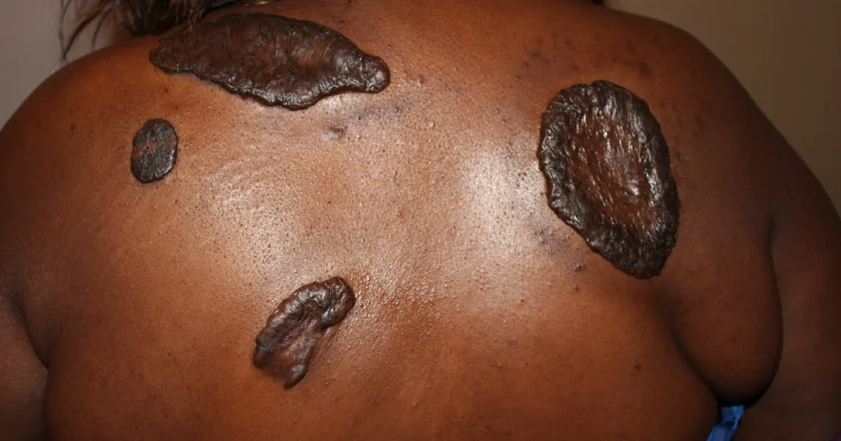 Multiple large keloids across a Black woman's upper back and shoulders.