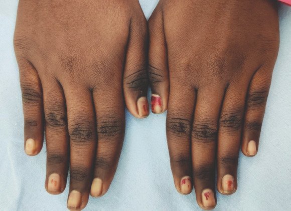 Two dark brown hands with darker, wrinkled patches over the knuckles.