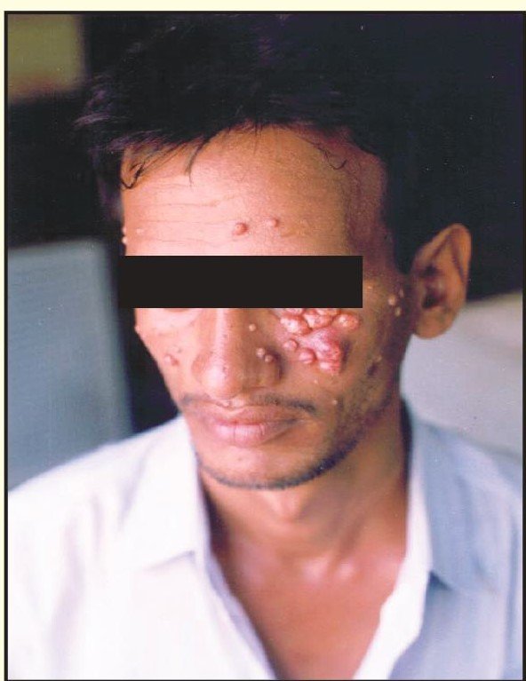 Many small pearly dome-shaped bumps on the face of a man with brown skin, eyes covered by a black bar.