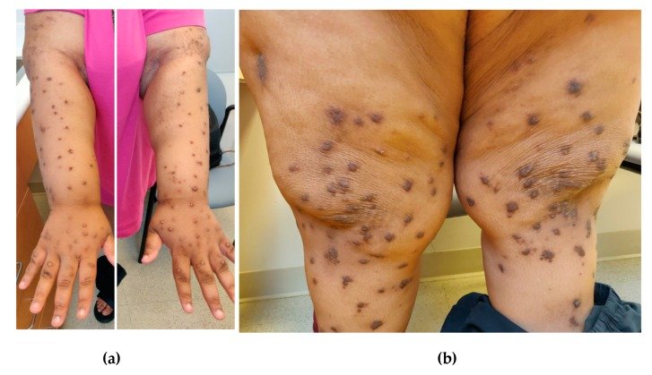 Dozens of small dark raised nodules spread over brown forearms, hands and both knees.
