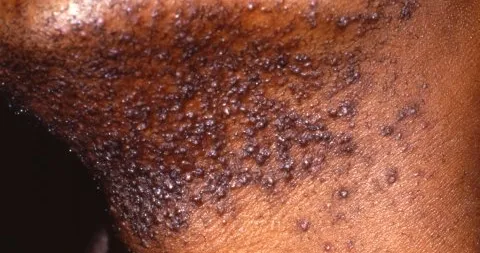 Pseudofolliculitis barbae along the jaw and neck on brown skin. Dark papules cluster where shaved hairs curl back into the follicle.