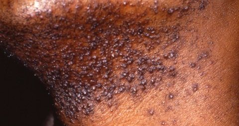 Pseudofolliculitis barbae along the jaw and neck on brown skin. Dark papules cluster where shaved hairs curl back into the follicle.
