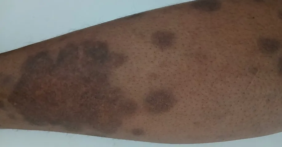 Psoriasis plaques on a brown-skinned lower leg. The plaques read brown and violet rather than the red shown in most textbooks.