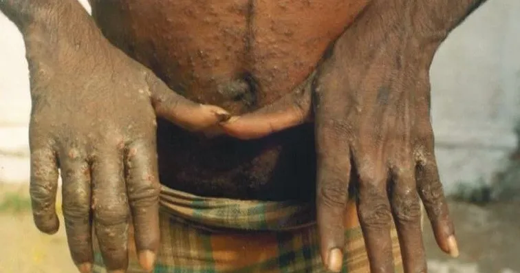 An adult with deep brown skin holds out both hands, showing crusted, raised scabies bumps across the fingers and backs of the hands, with scattered small papules over the stomach and waistline, two classic sites for the mite.
