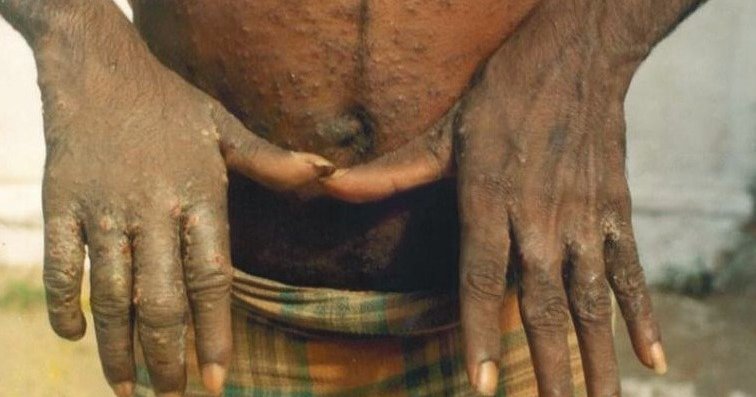 An adult with deep brown skin holds out both hands, showing crusted, raised scabies bumps across the fingers and backs of the hands, with scattered small papules over the stomach and waistline, two classic sites for the mite.