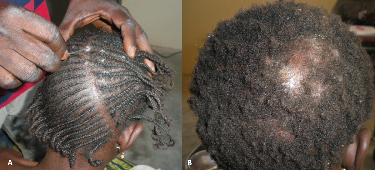 Scalp ringworm on two Black children: white scaling along cornrow partings, and a scaly patch with hair loss on the crown