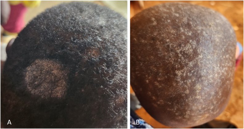 Scalp ringworm on two Black children: one large round patch of hair loss with grey scaling, and a crown covered in small scaly patches with broken hairs