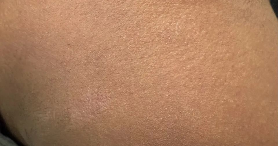 Tinea corporis at the nape of the neck on brown skin. The ring reads brown and faintly raised rather than red.