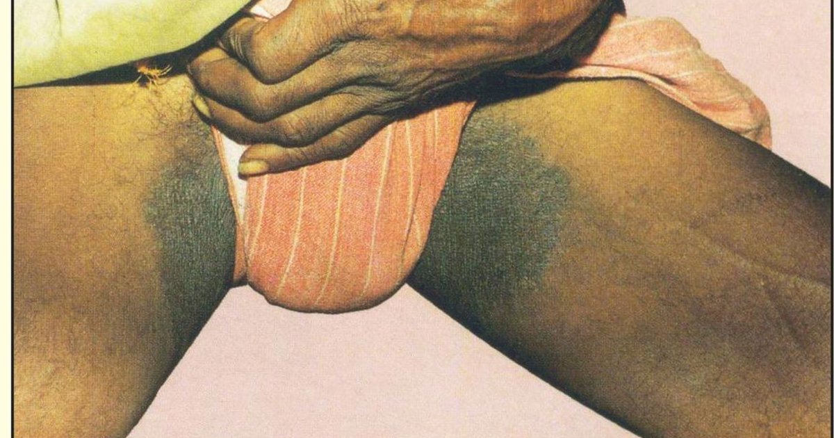 Tinea cruris on dark brown skin: dark gray-brown patches spread across both inner thighs along the groin crease, with the underwear held up to show them.