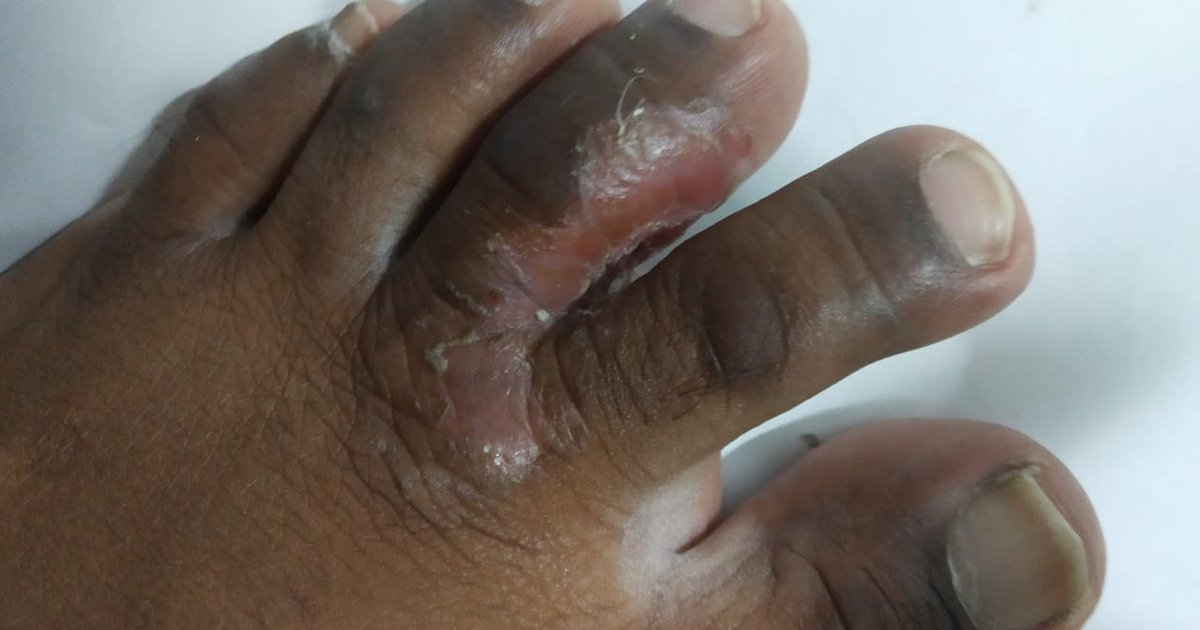 Athlete's foot on dark brown skin: a raw, peeling split between two toes with white scale at its edges.