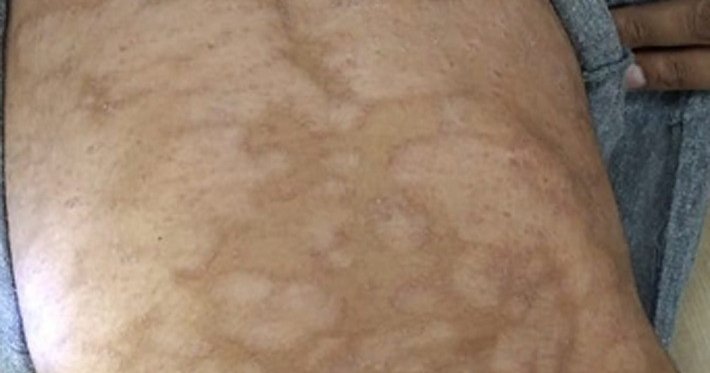 A Black man photographed from behind in warm natural light, the bare skin of his upper back and shoulders filling the frame, the area of the body where tinea versicolor most often appears.