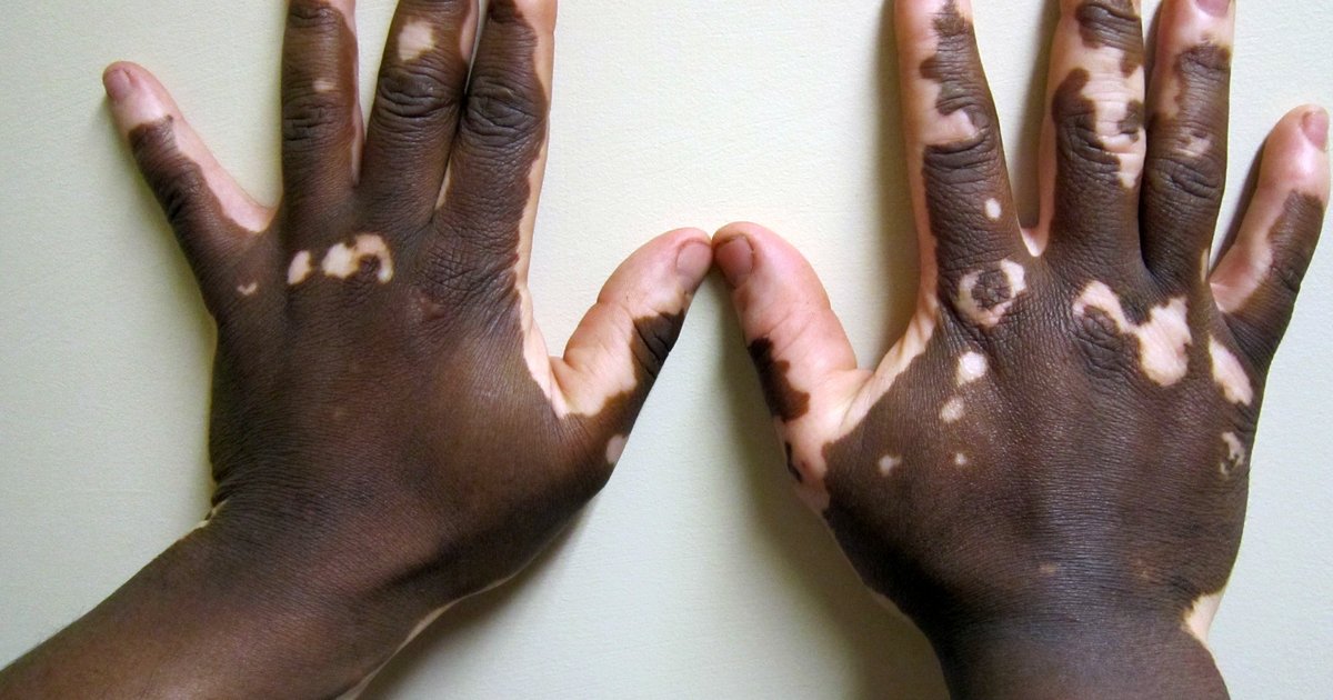 The backs of two dark-skinned hands with vitiligo: sharply bordered, milk-white patches on the knuckles, fingers and thumbs, some forming rings around darker skin.
