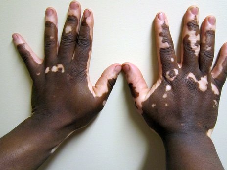 White Spots on Black Skin: Common Causes and When to Worry
