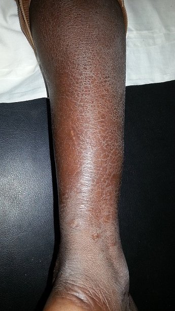 Severe dry skin on a dark-skinned lower leg showing cracked, fish-scale polygonal scaling from shin to ankle